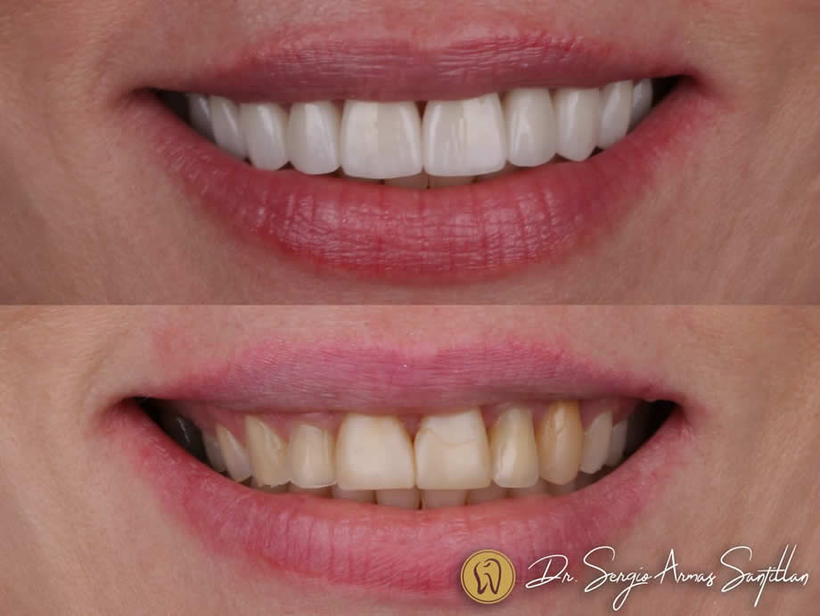 Carillas-porcelana-Dentista-en-Reynosa
