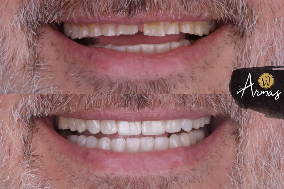 Carillas de Disilicato de Litio