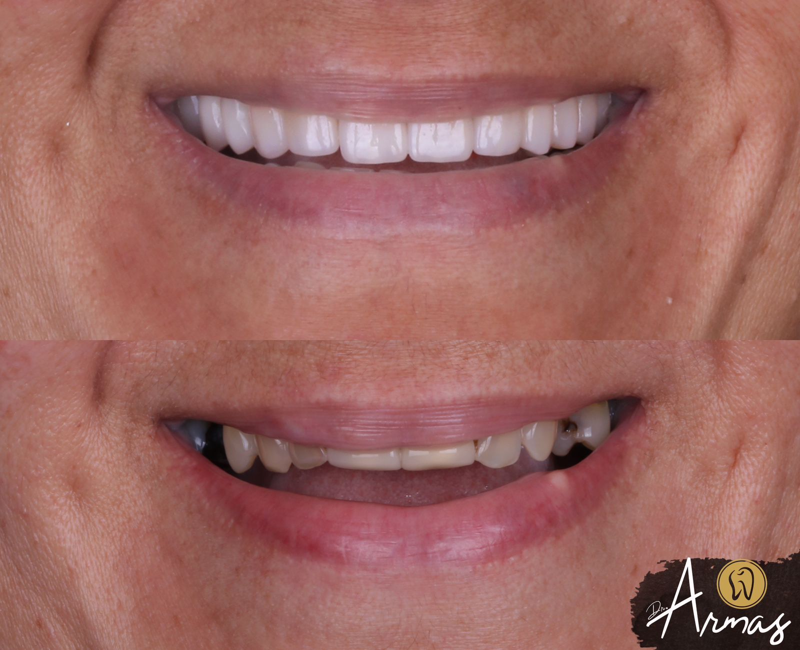 CarillasPorcelana-DrSergioArmas-DentistaReynosa-Abril2023-1