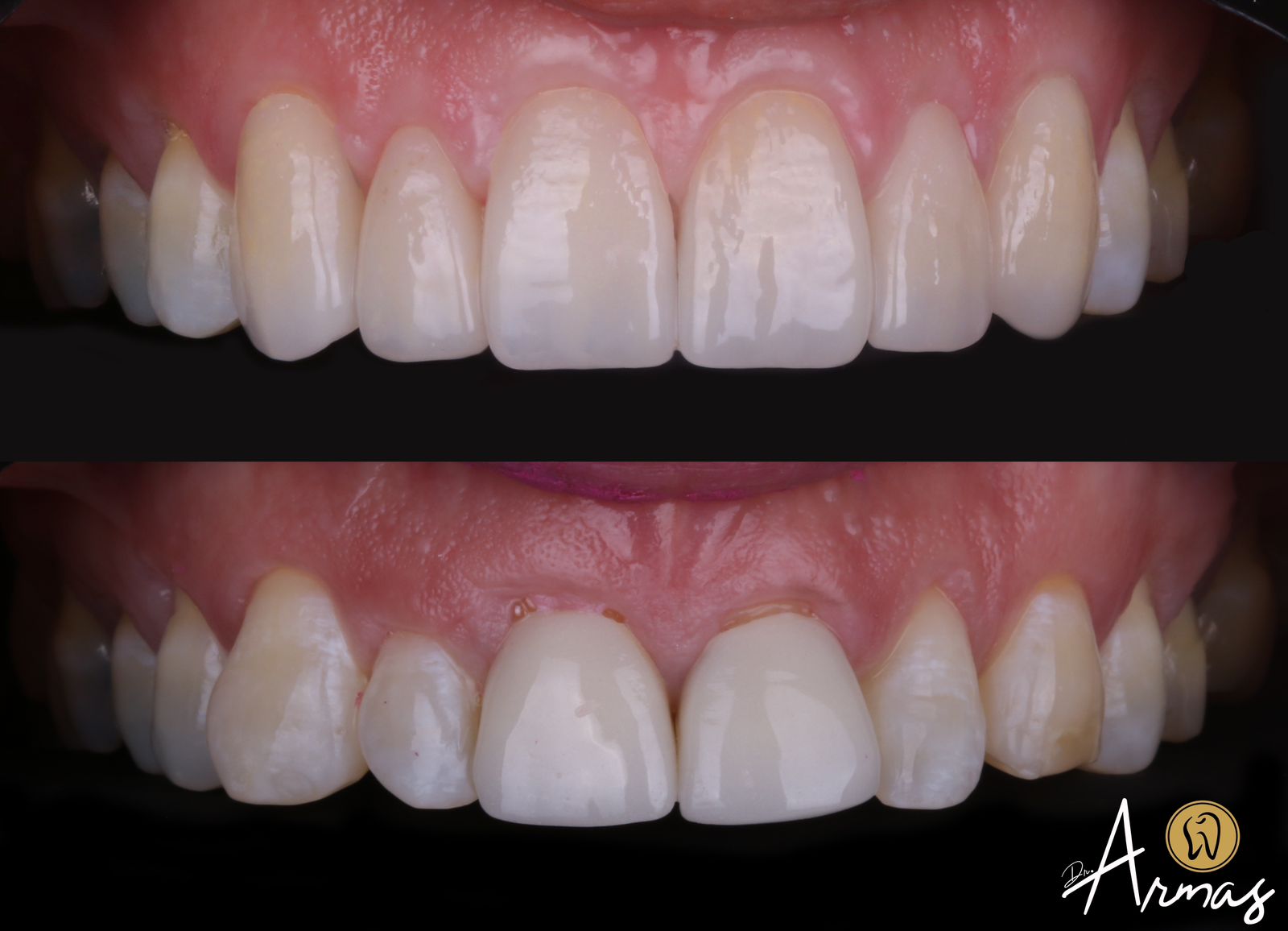 CarillasPorcelana-DrSergioArmas-DentistaReynosa-Abril2023-2