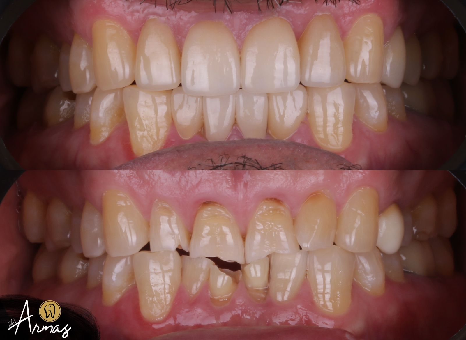 CarillasPorcelana-DrSergioArmas-DentistaReynosa-Abril2023-4