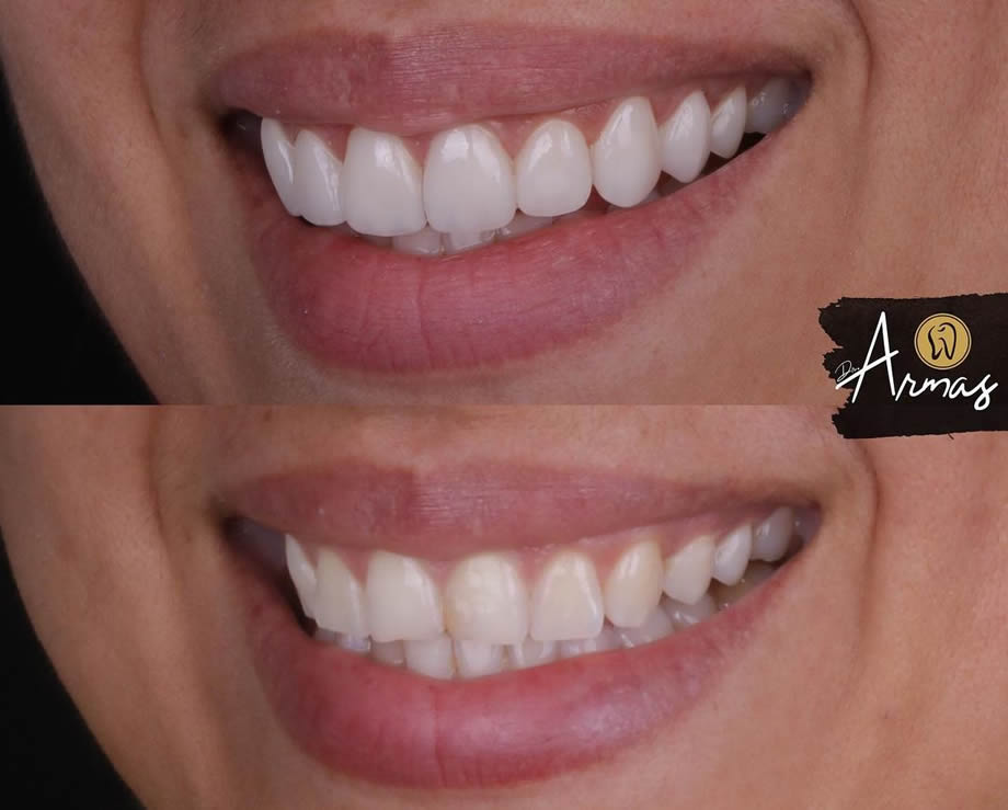 CarillasPorcelana-DrSergioArmas-DentistaReynosa-Ene2023-02