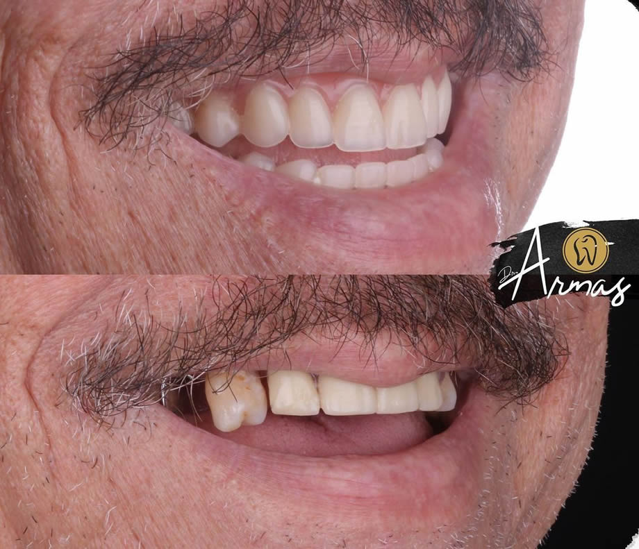 CarillasPorcelana-DrSergioArmas-DentistaReynosa-Ene2023-03