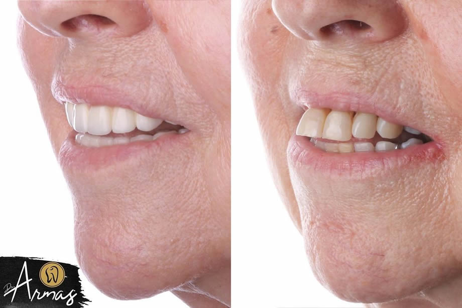CarillasPorcelana-DrSergioArmas-DentistaReynosa-Ene2023-05
