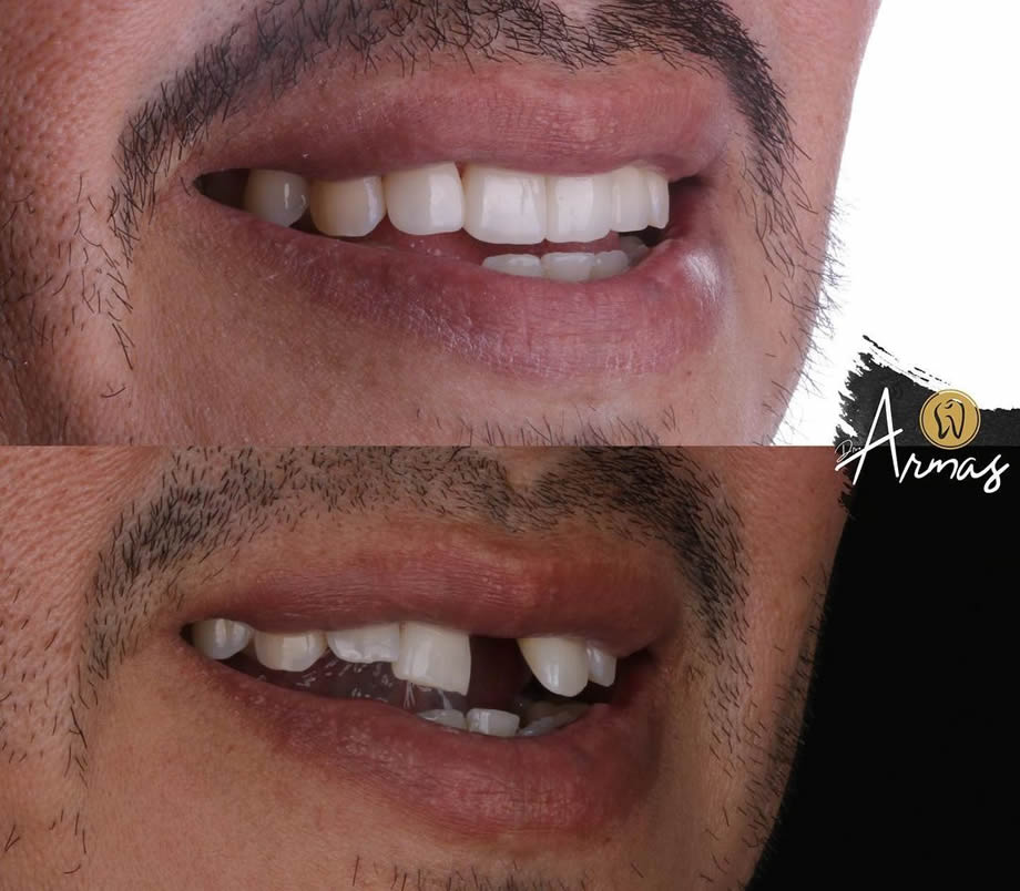 CarillasPorcelana-DrSergioArmas-DentistaReynosa-Ene2023-06