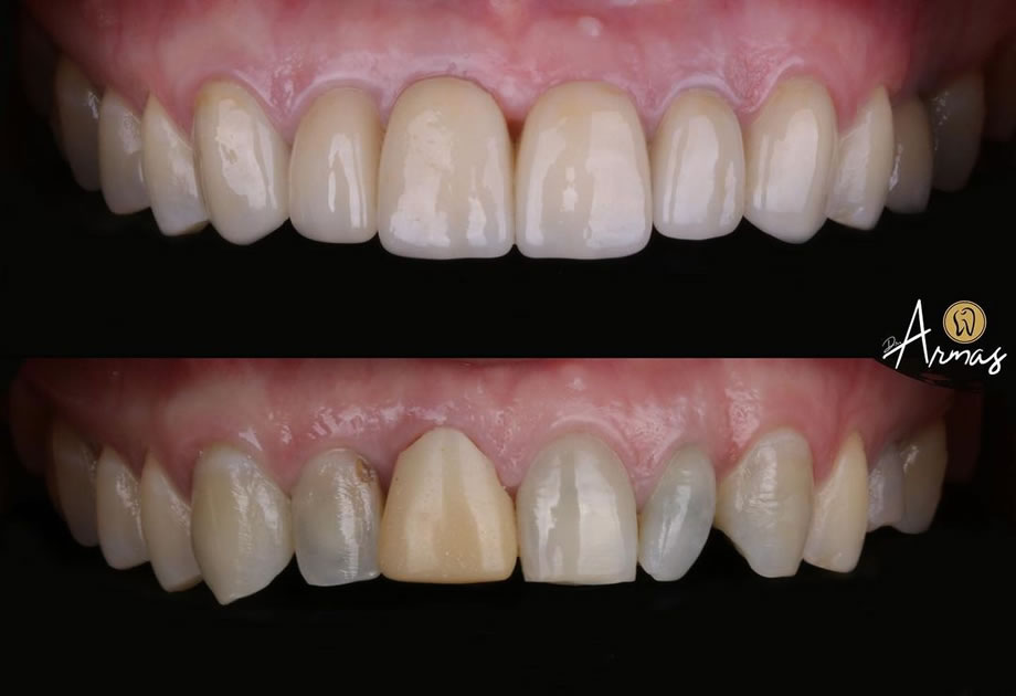 CarillasPorcelana-DrSergioArmas-DentistaReynosa-Ene2023-07