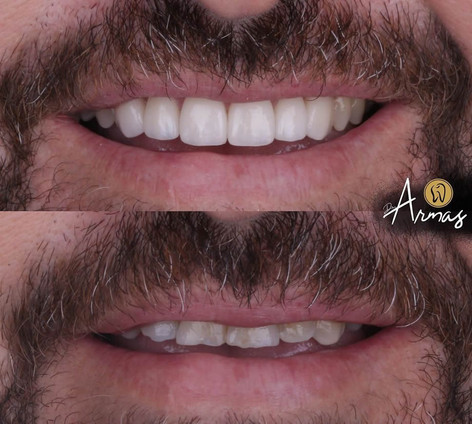 CarillasPorcelana-DrSergioArmas-DentistaReynosa-Ene2023-08