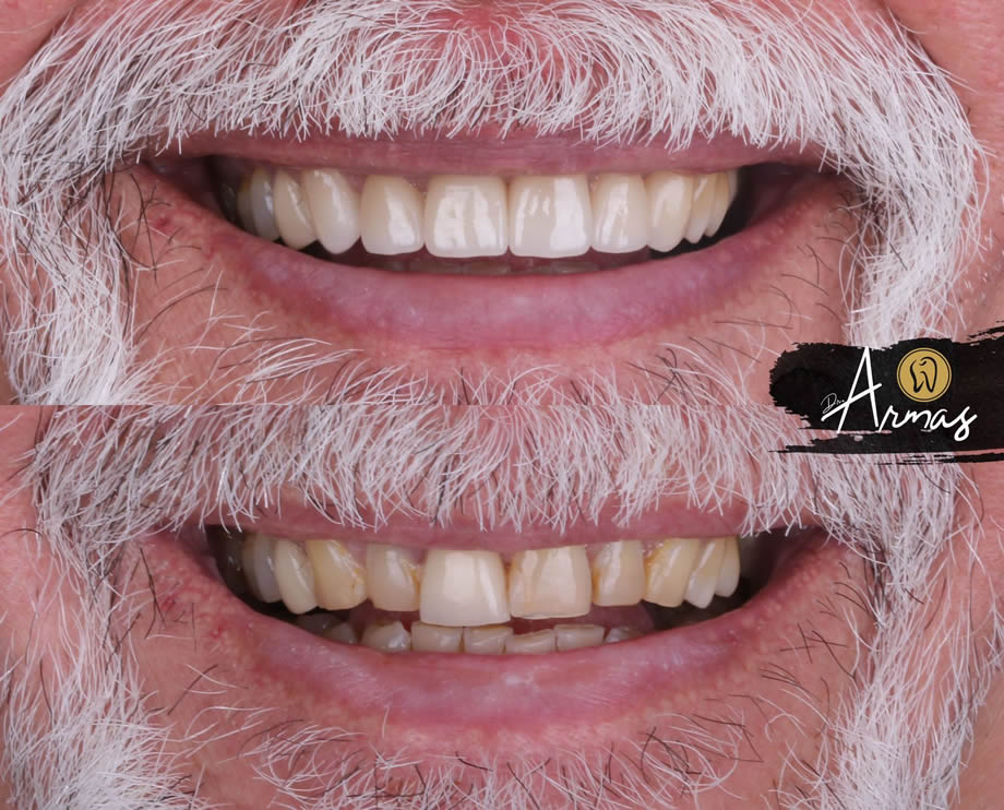 CarillasPorcelana-DrSergioArmas-DentistaReynosa-Mzo23-01