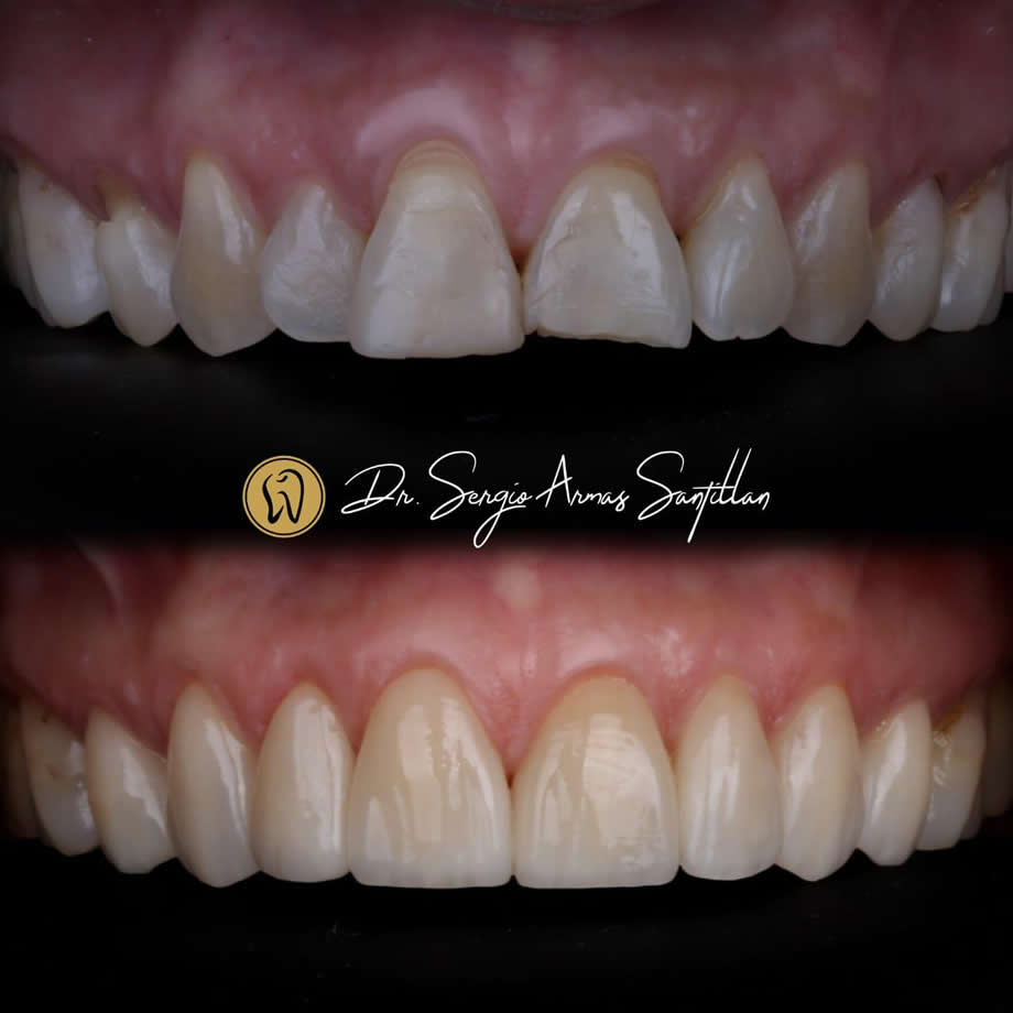 carillas-de-porcelana-dentistas-reynosa