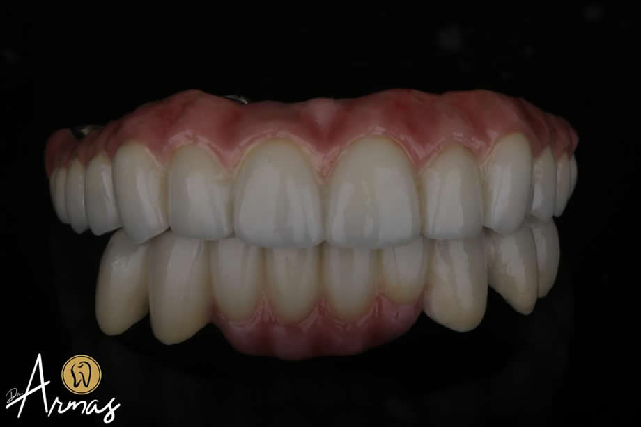 carillas-implantes-dentales-dr-sergio-armas-dentista-en-reynosa