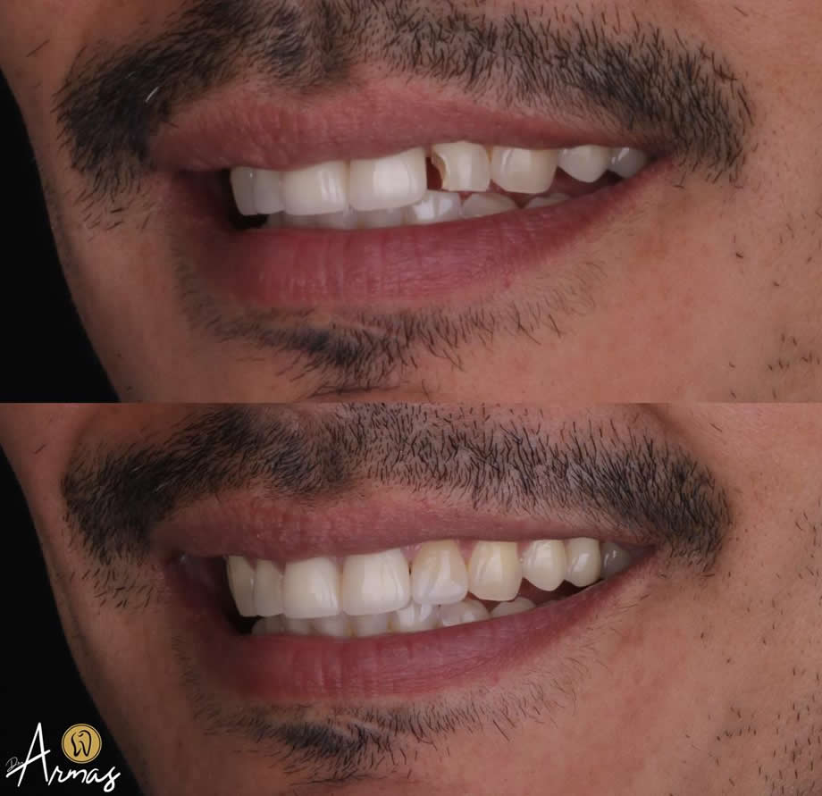 carillas-porcelana-dr-sergio-armas-dentista-del-prado-reynosa