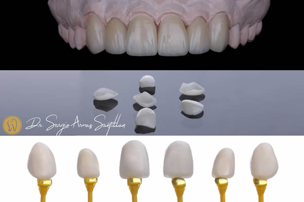 carillas-porcelana-dr-sergio-armas-dentista-en-reynosa