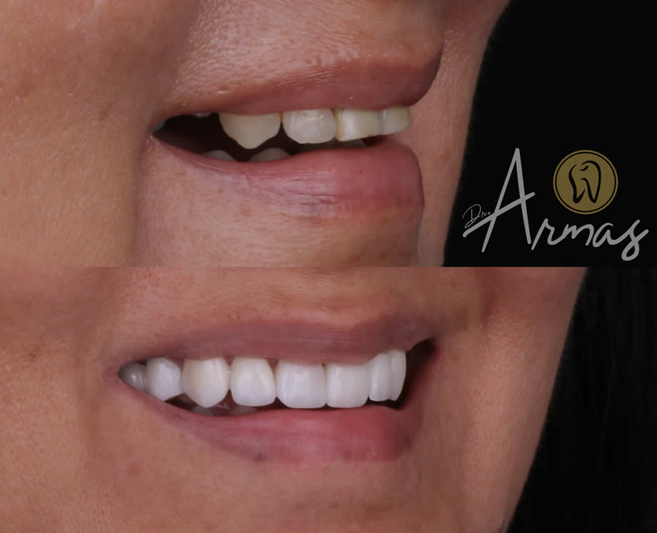 carillas-porcelana-drsergioarmas-dentista-reynosa-01-22