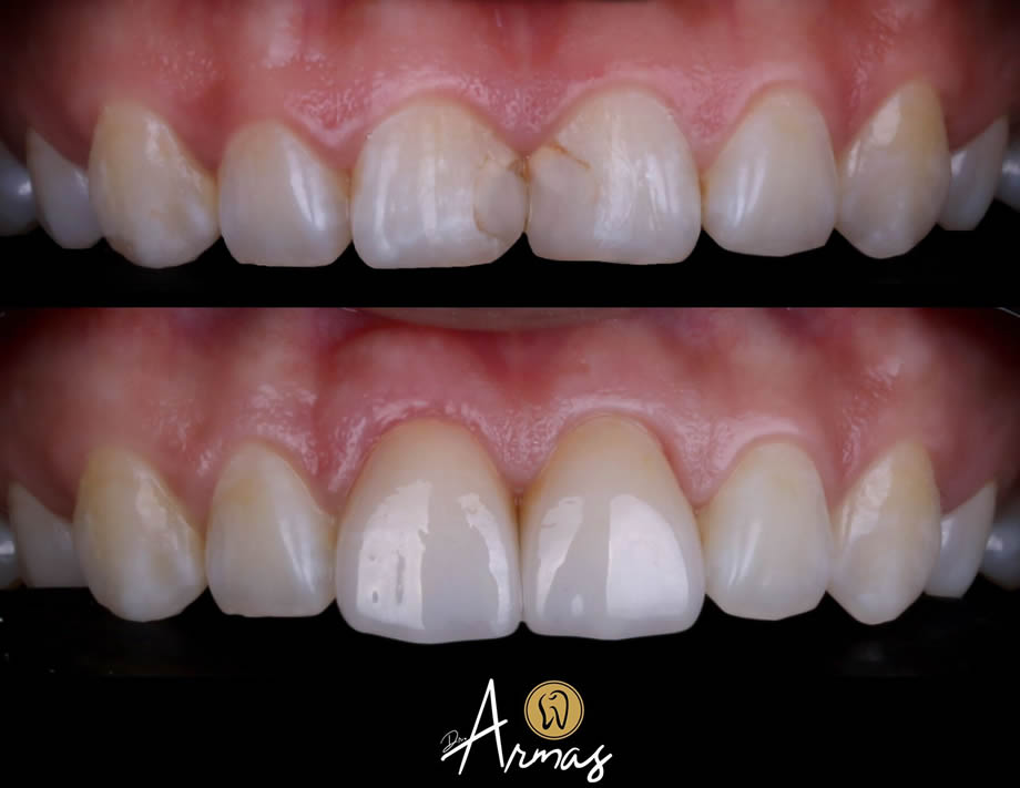 carillas-porcelana-drsergioarmas-dentista-reynosa-02-22-1