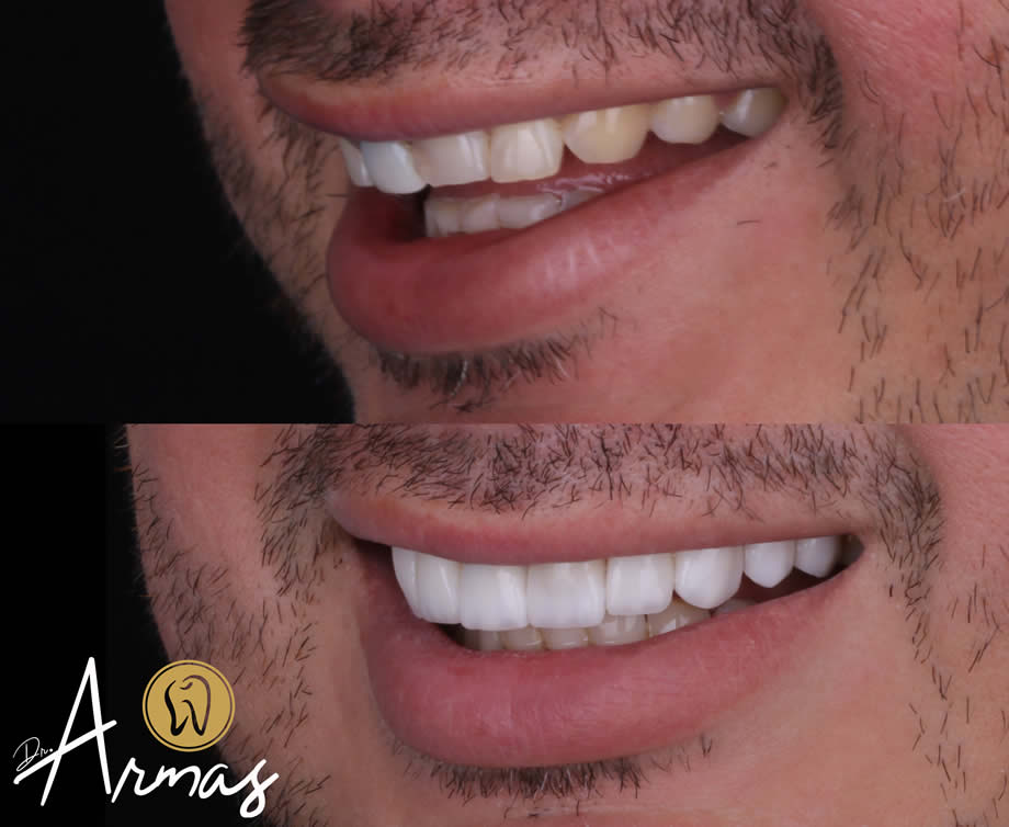 carillas-porcelana-drsergioarmas-dentista-reynosa-02-22