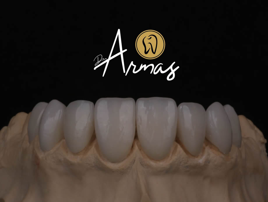 carillas-porcelana-drsergioarmas-dentista-reynosa-03-22