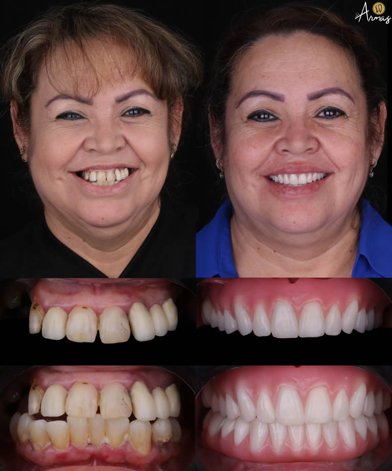dentadura-superior-estructura-sobre-implantes