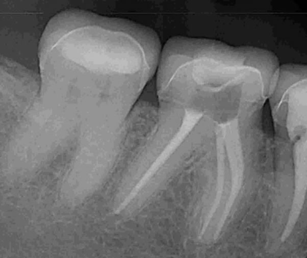 endodoncia-antes