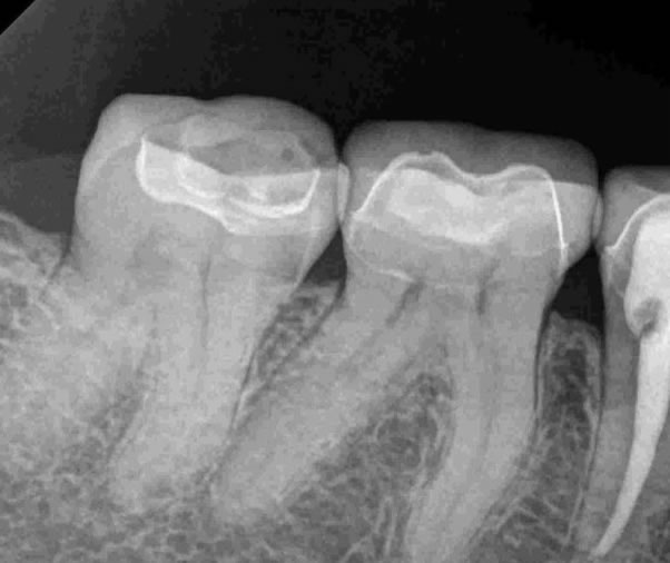 endodoncia-despues