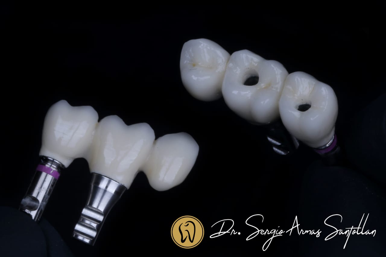 implantes-dentales-dentistas-reynosa