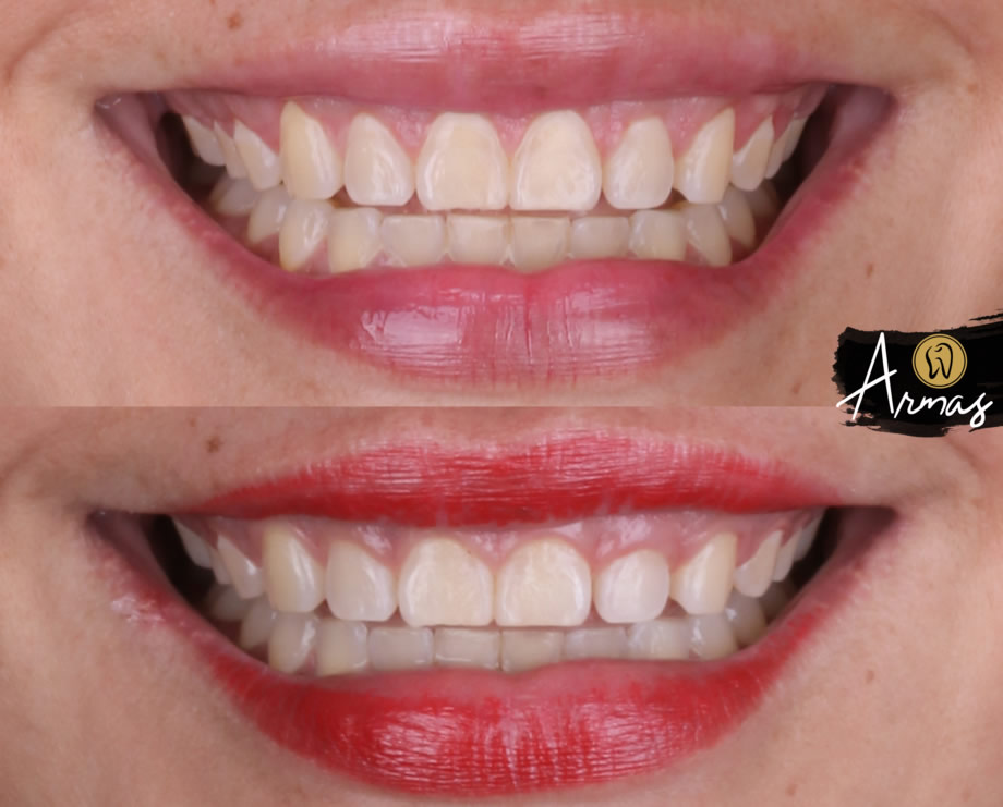 implantes-dentales-dr-sergio-armas-reynosa-may2024-3