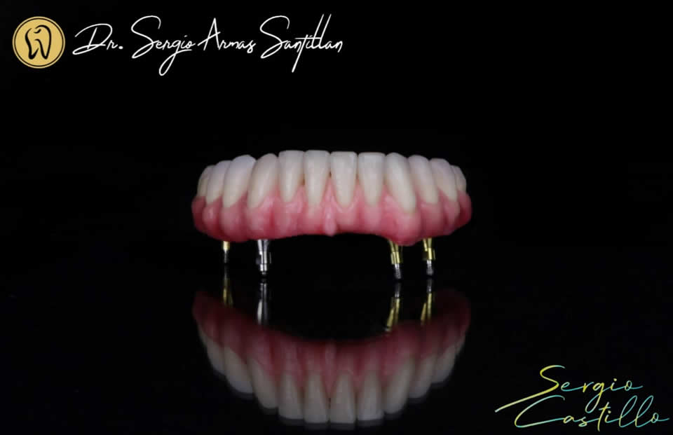 protesis-inferior-implantes-dentales-reynosa