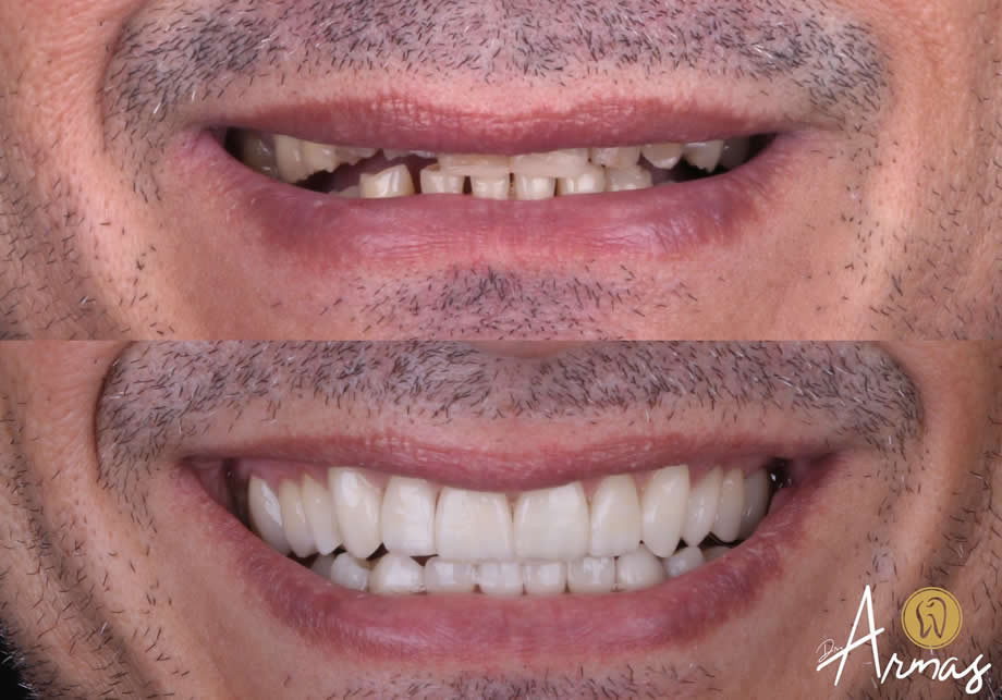 reconstruccion-en-porcelana