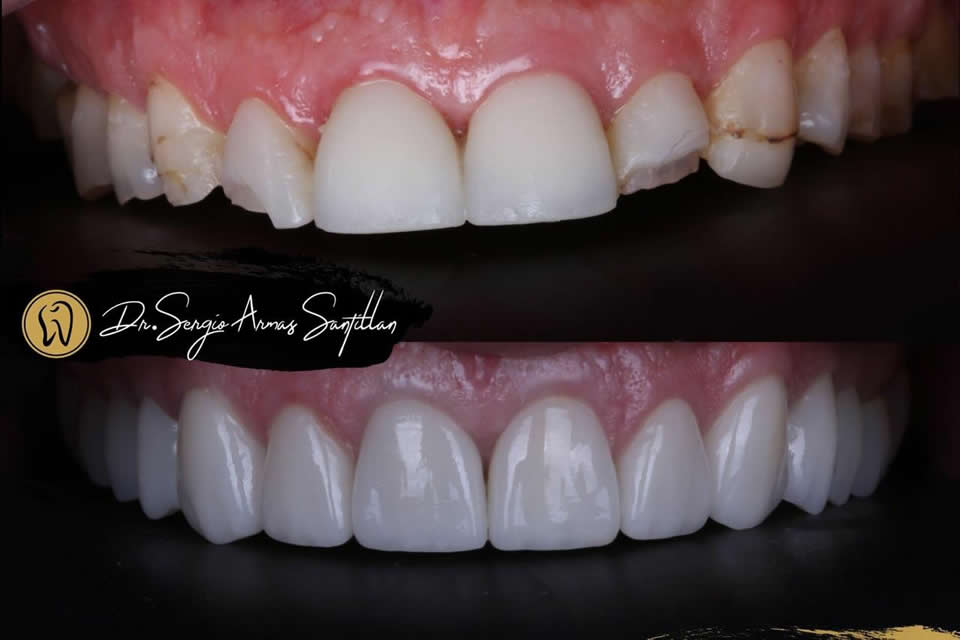 rehabilitacion-construccion-completa-dentistas-implantes-dentales-reynosa